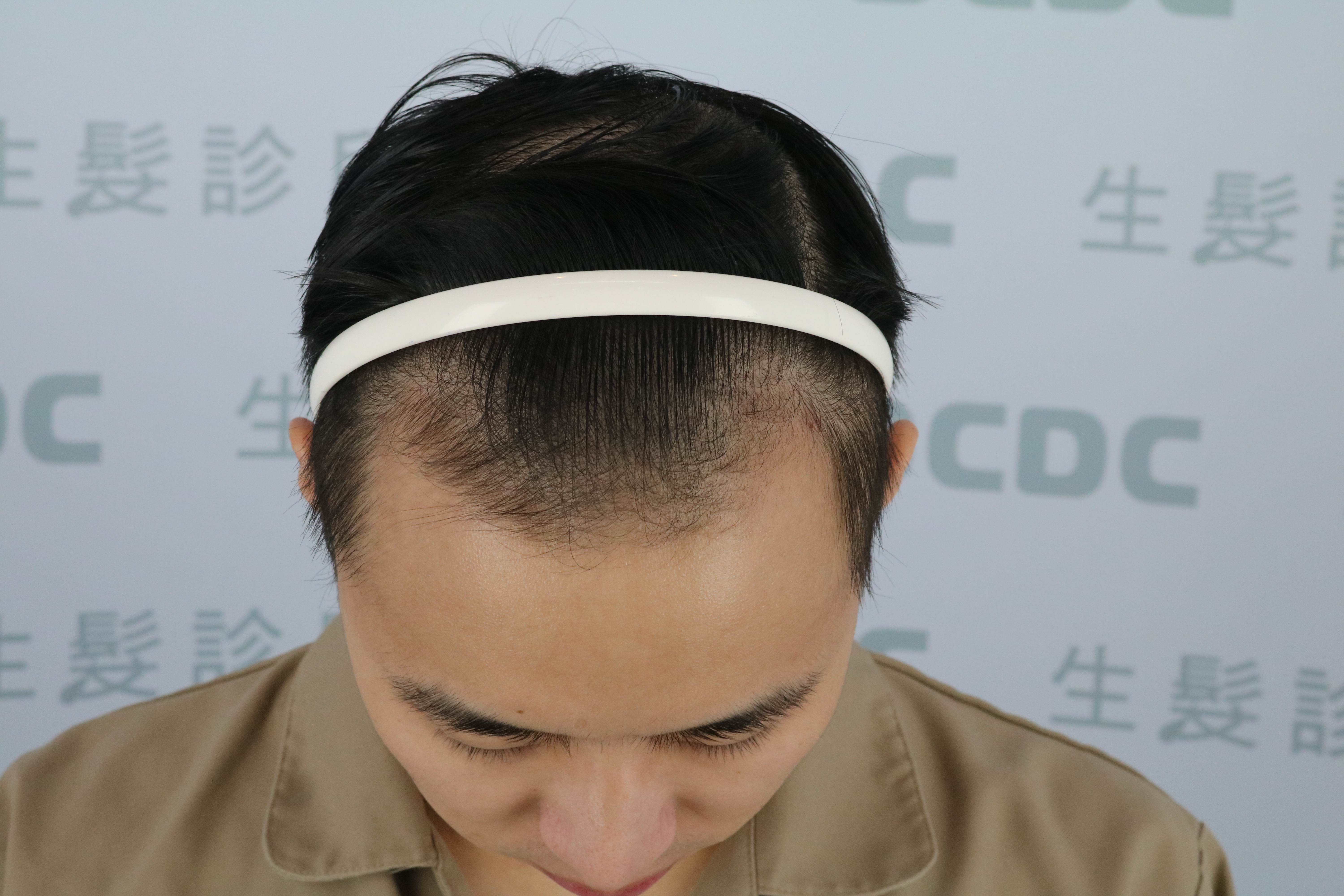 DCDC生髮診所-雄性禿第三至四期額角及頂部掉髮術前角度評估